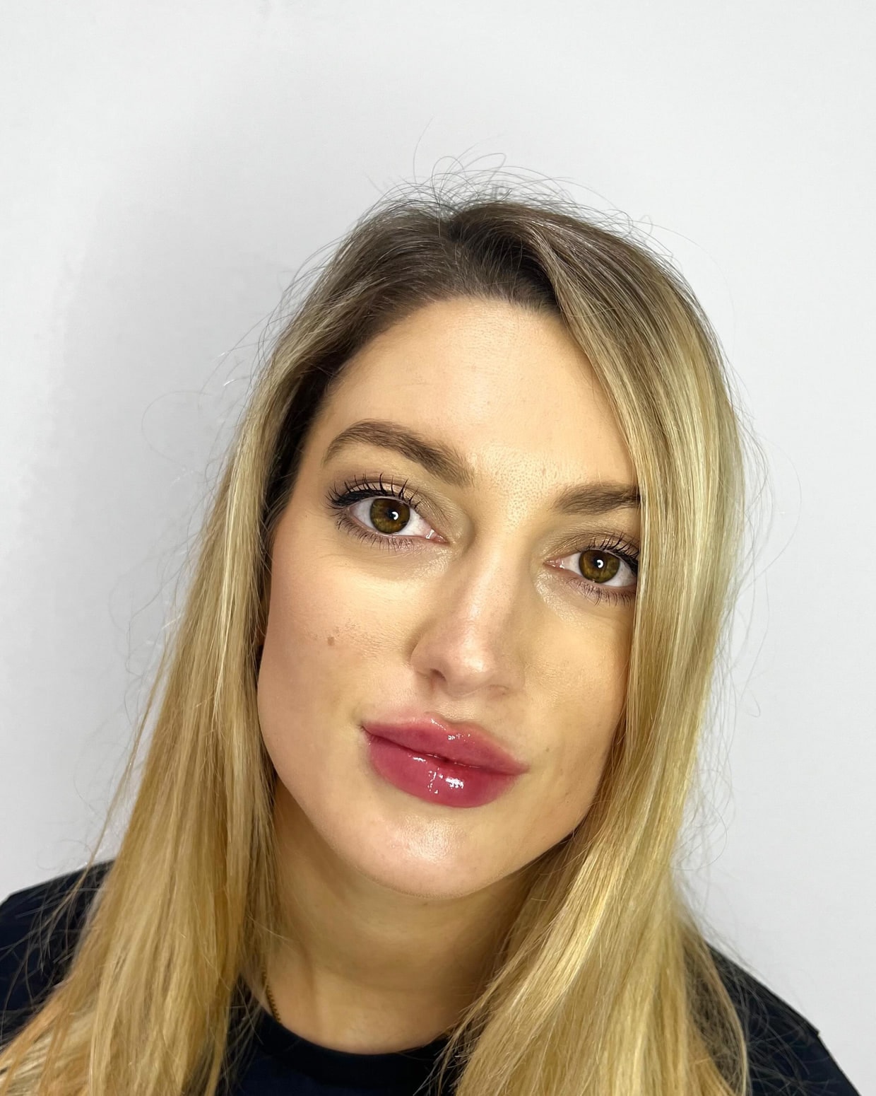 A client after lip enhancement